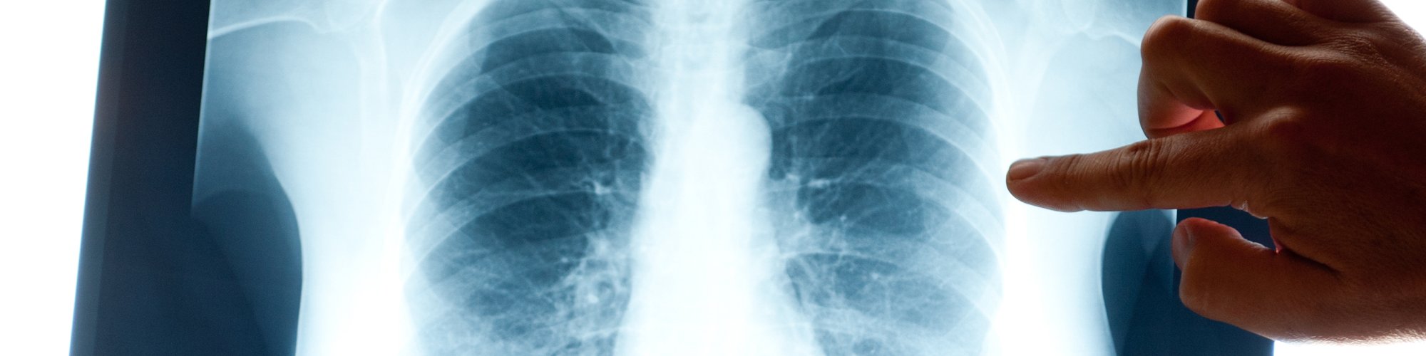 An x-ray shown by Scott Mitchell, director of radiology.